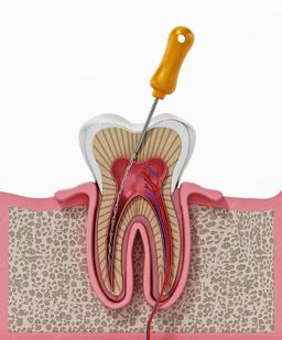 https://admin.realteethclinic.com/uploads/Endo_a107e1c6ae.webp